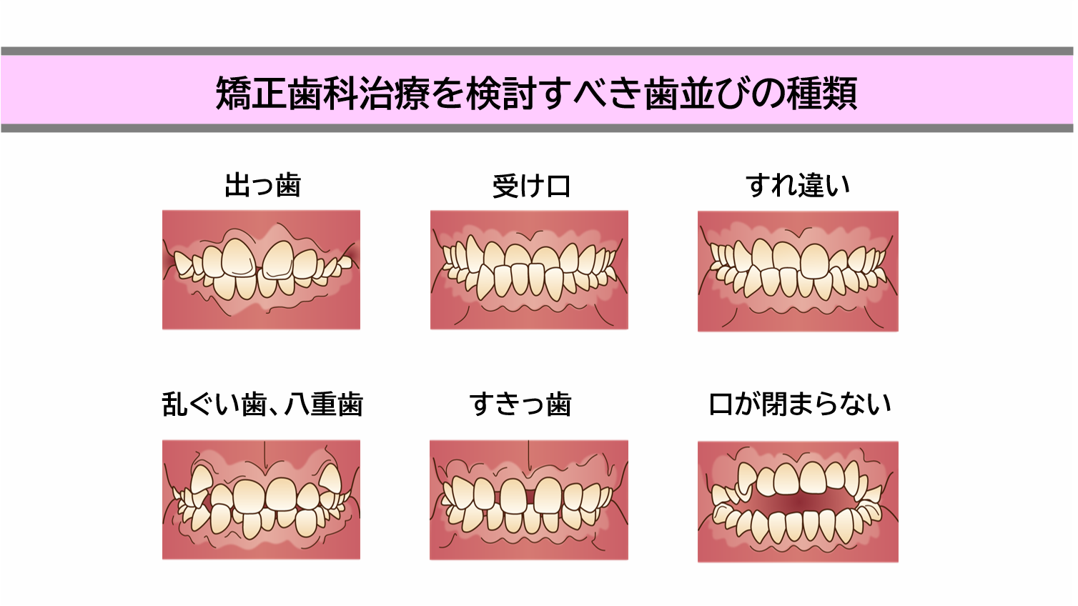 矯正歯科治療を検討すべき歯並びの種類