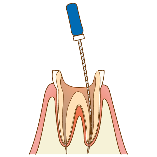 リーマー（ファイル）で細菌に感染した骨髄（神経や血管）を除去し、キレイになった歯