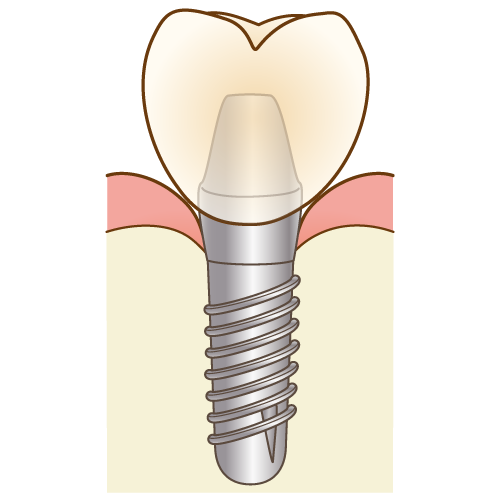 インプラント治療