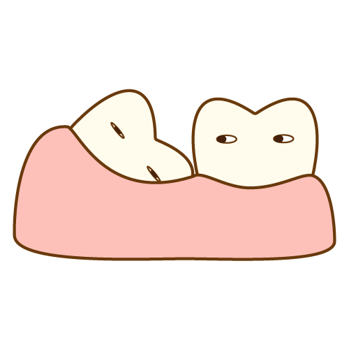 親知らずの抜歯