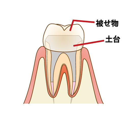 キレイになれば、その上にかぶせ物を入れます