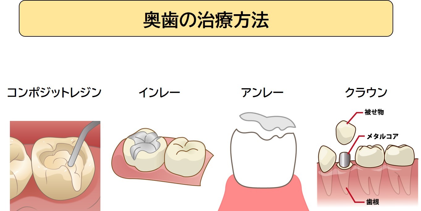 奥歯の治療方法