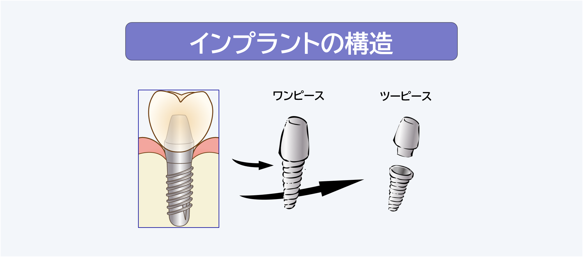 インプラントの構造