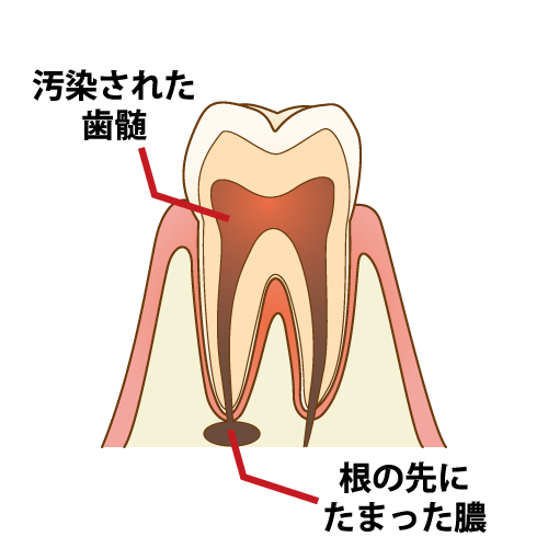 汚染された歯の神経