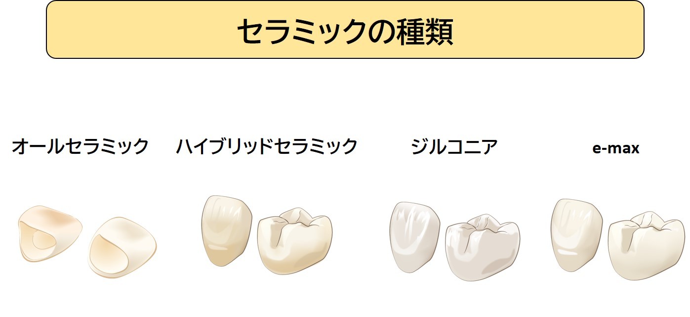 セラミックの種類