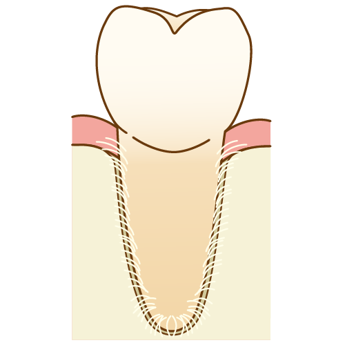 歯が折れた（歯根破折）