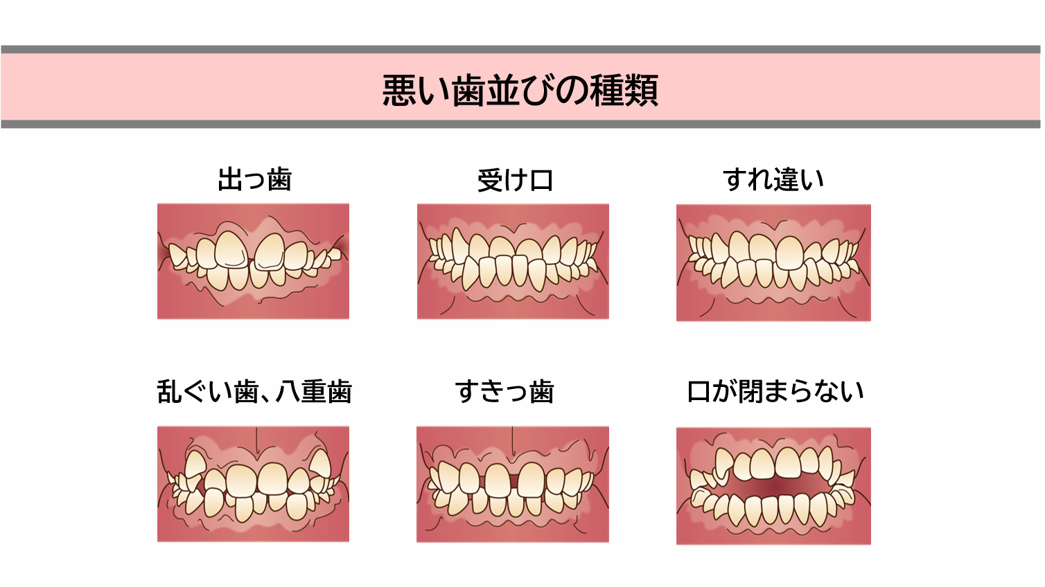悪い歯並びの種類とその原因と弊害
