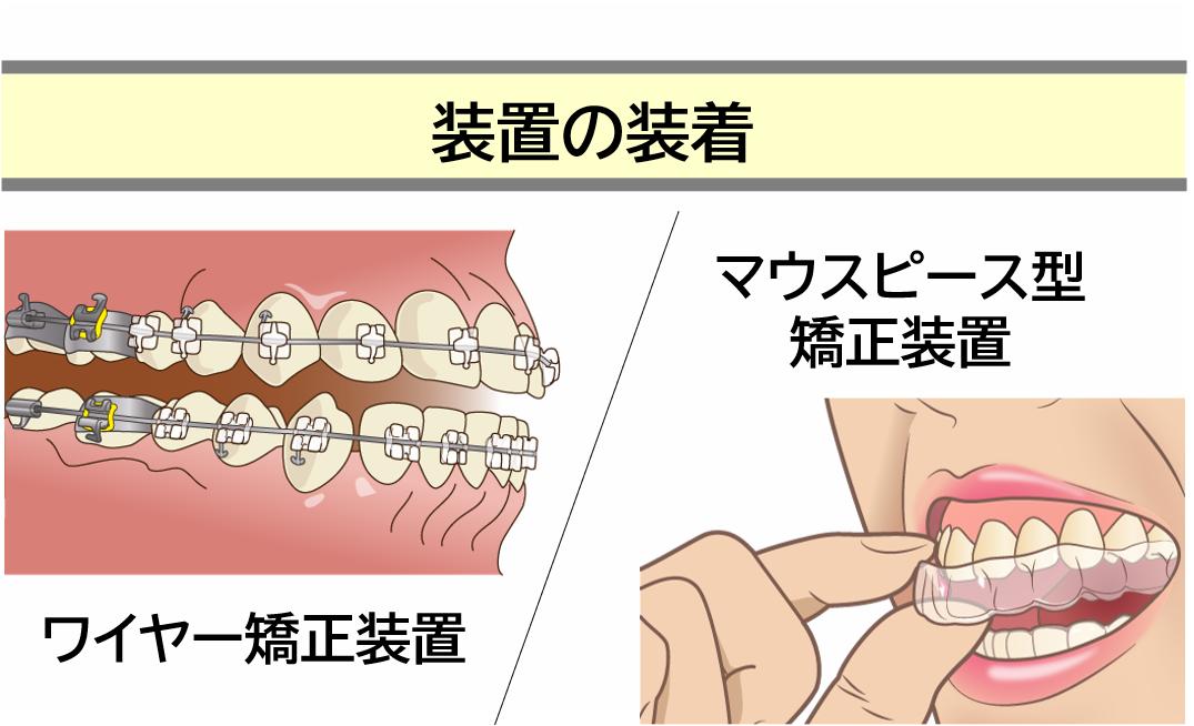 治療STEP3：矯正治療（治療期間2～3年）