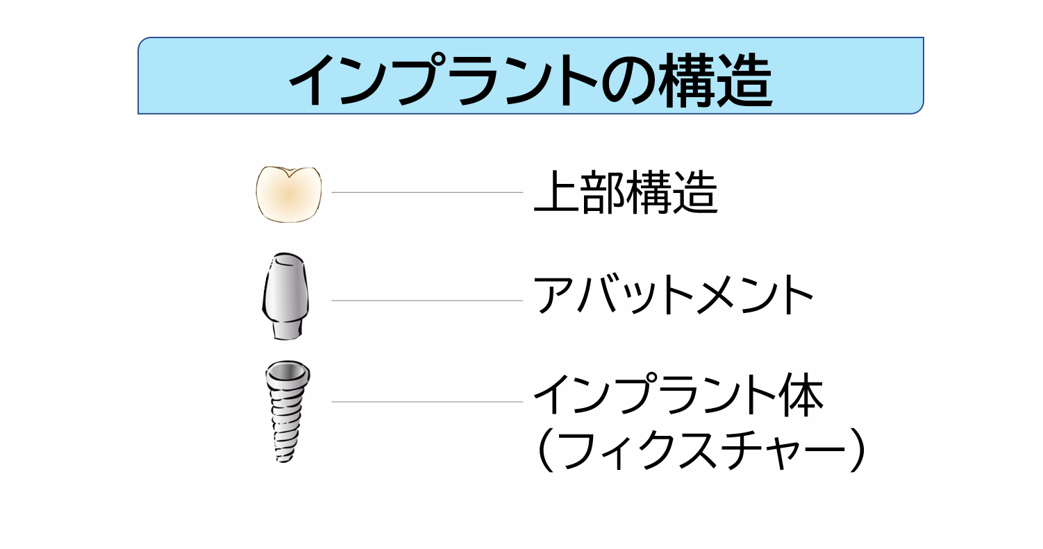 インプラントの構造
