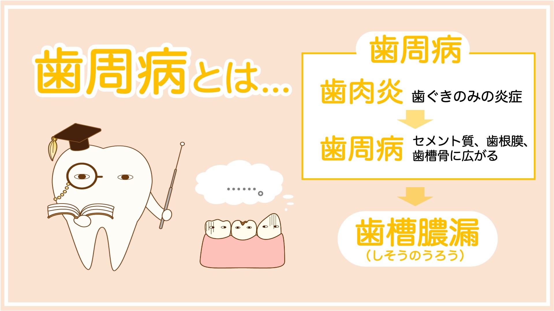 「歯周病」「歯肉炎」「歯槽膿漏」「歯周炎」の症状の違いは？