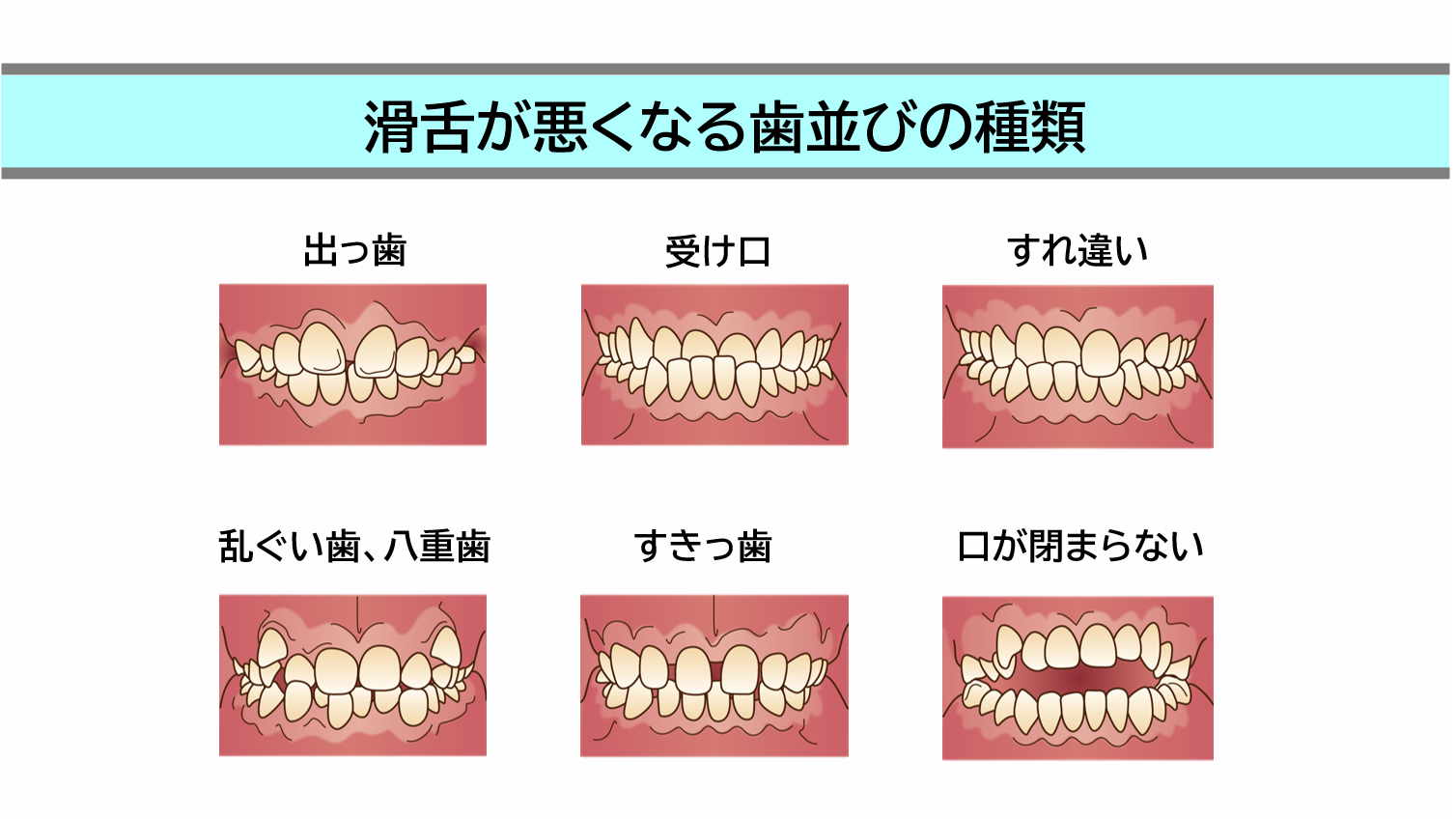 滑舌が悪くなる歯並びの種類