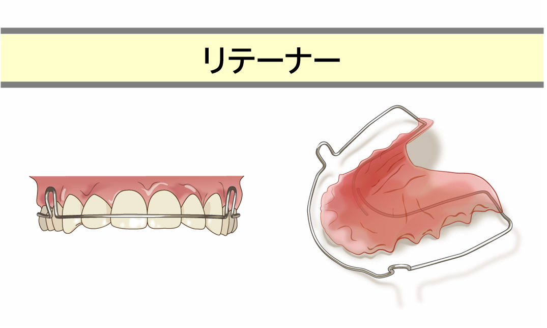 治療STEP4：保定（治療期間2～3年）