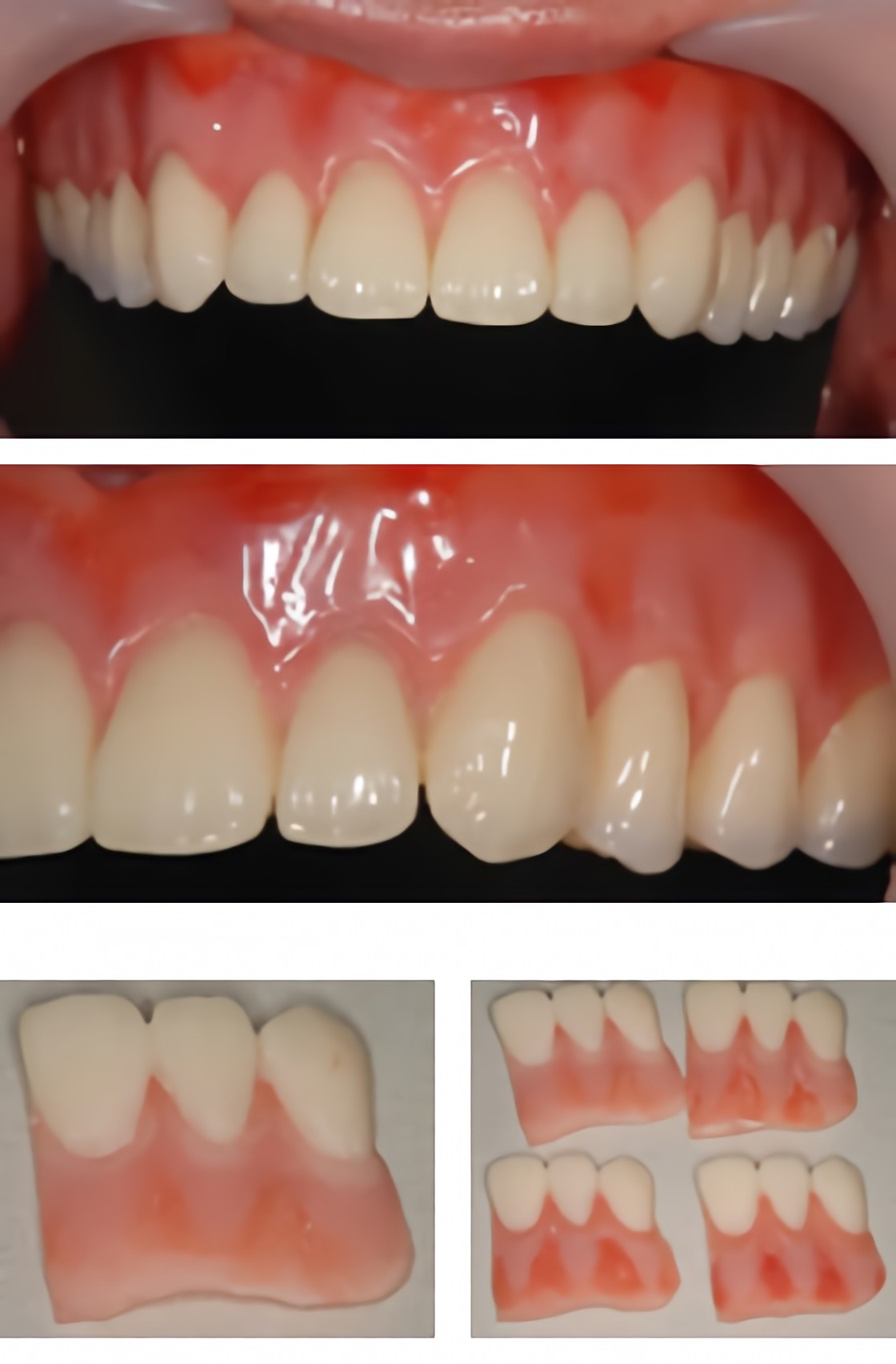 カラーリングデンチャー