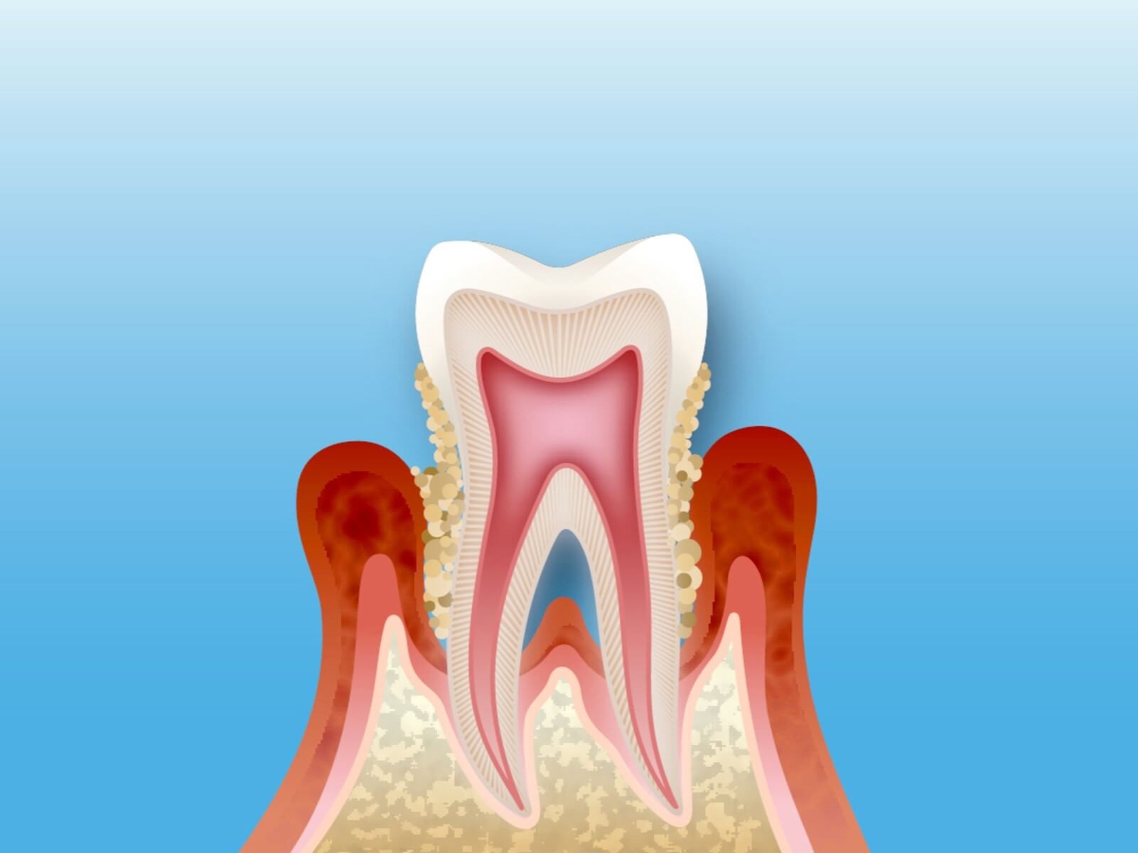 定期検診や専門的なクリーニングで歯周ポケット内のプラークや歯石を取り除くケアを行っています