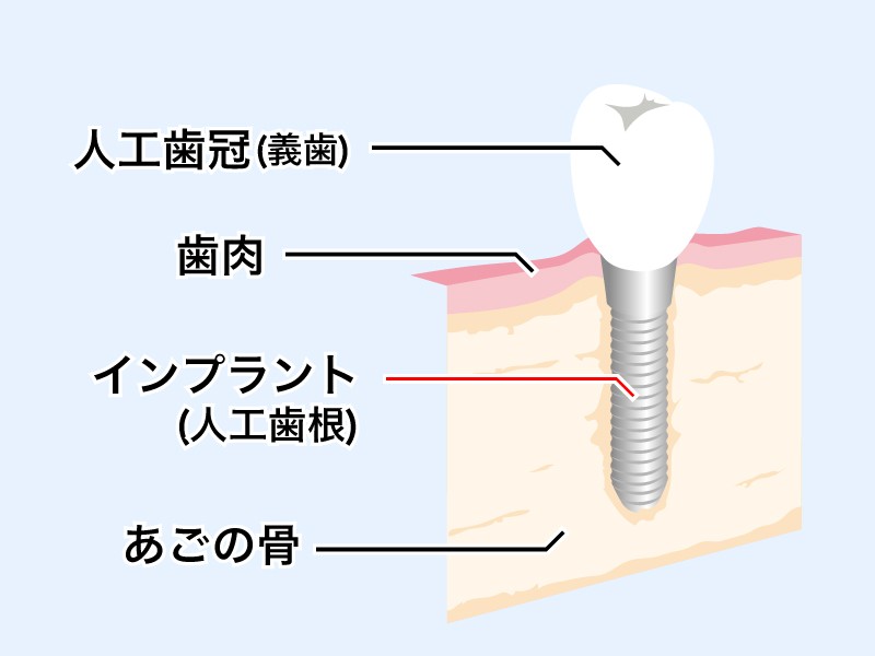 固定式で噛み心地を重視した人工歯を用います