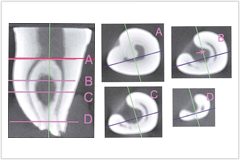根の複雑さに対し正確に治療を行います