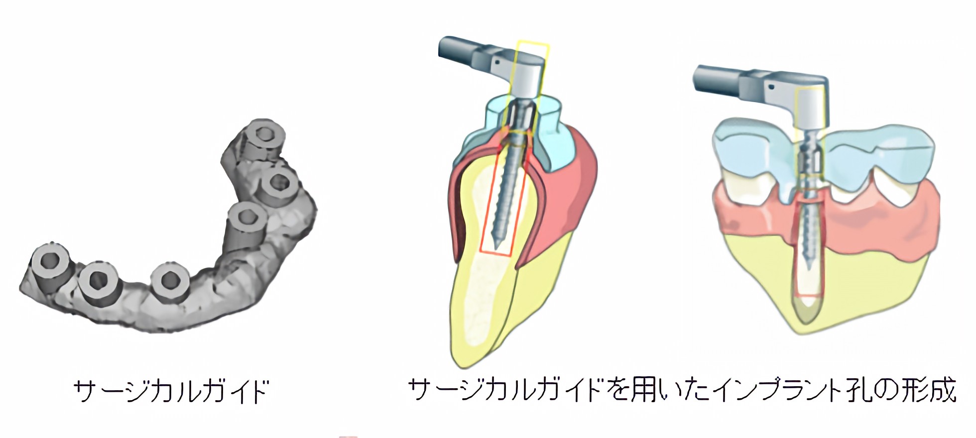 サージカルガイドを使用した治療