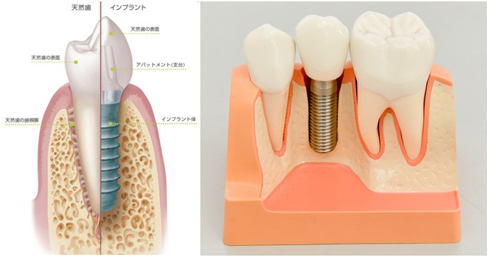 歯を失ってお困りの方へ