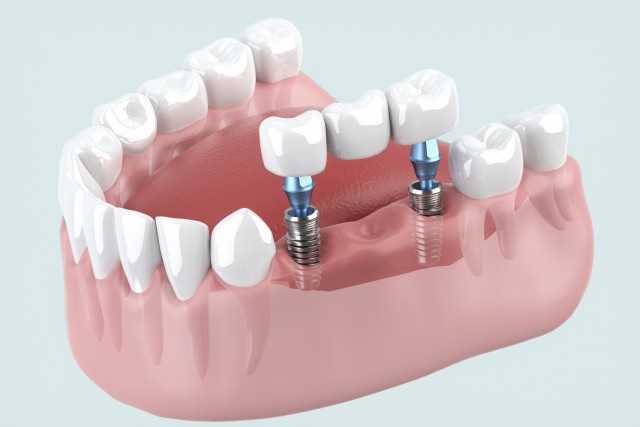自分の歯に近い感覚で使える治療法としてインプラント治療を提案しています。※写真はイメージです。