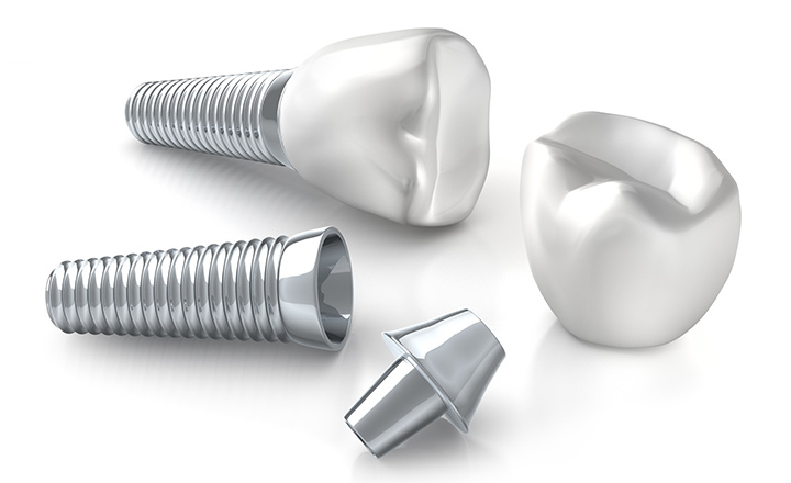 インプラントは自分の歯のような使用感を実現できます