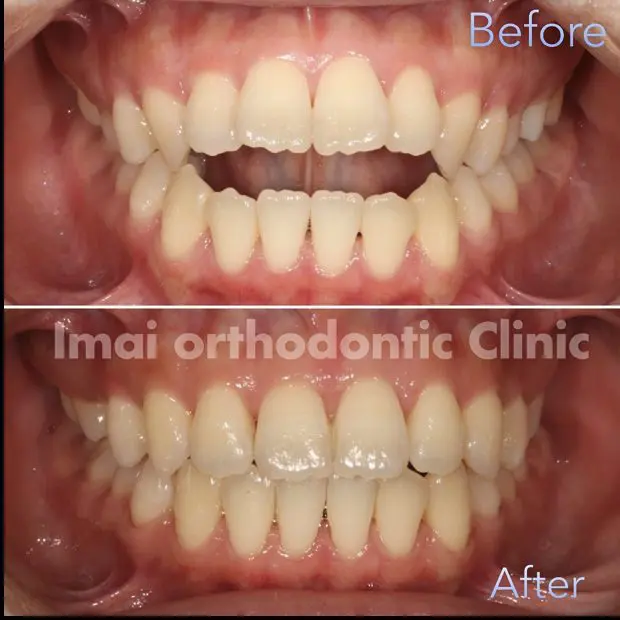 歯並びが悪いと、全身の不調にも繋がります