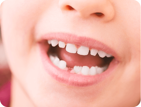 お子様の歯を守るために今できること―わかまつ歯科医院の予防歯科