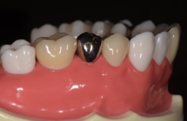 クラウン（かぶせ物）