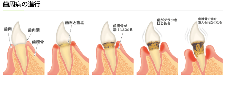 歯周病の進行