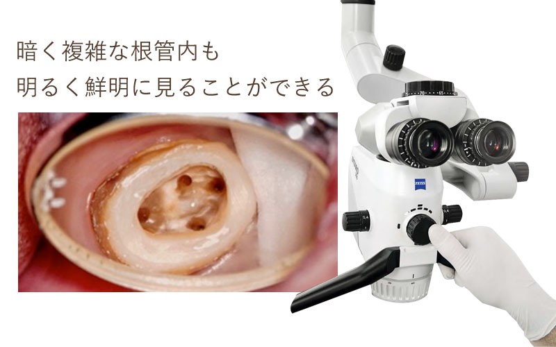 治療にはマイクロスコープを活用しています