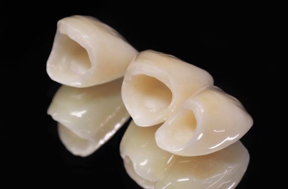 セラミックの虫歯治療を推奨しています