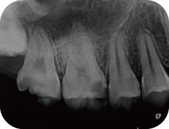 歯髄を残すことも可能です