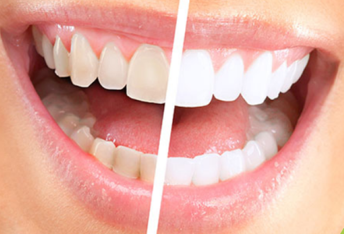 痛みに配慮したホワイトニングで輝く笑顔を