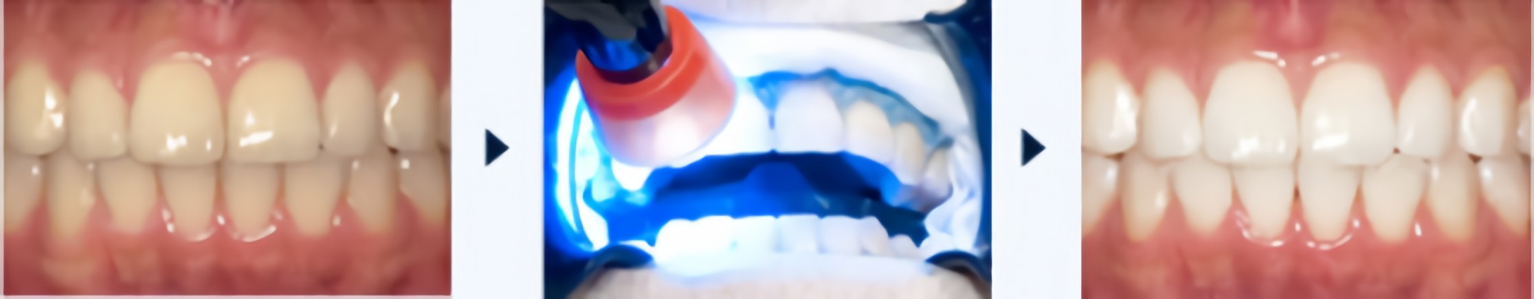 最適なホワイトニングをご提案いたします