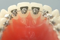 外から装置が見えにくい状態で矯正治療を進めることができます