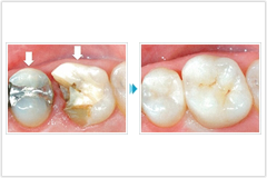 知覚過敏症の治療を行います