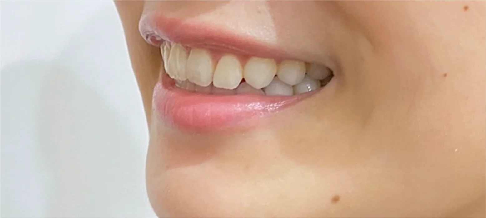 自然な白さで笑顔に自信を