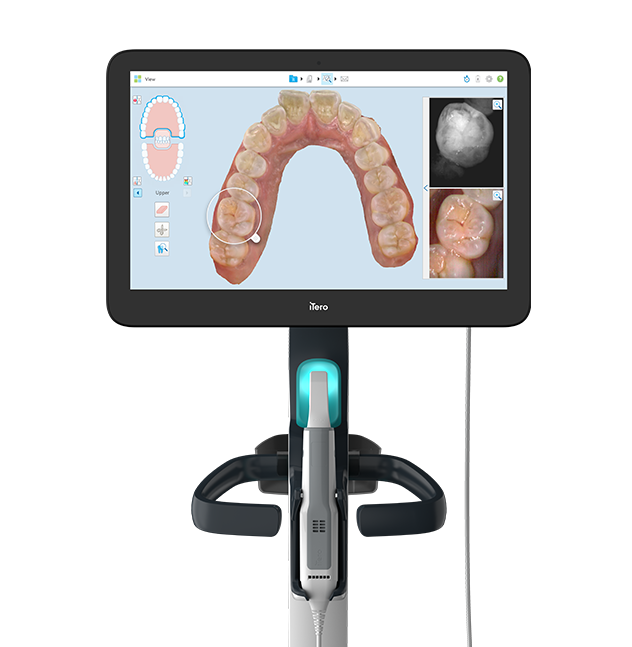 口腔内スキャナーにより正確な診断と矯正装置を作製することができます