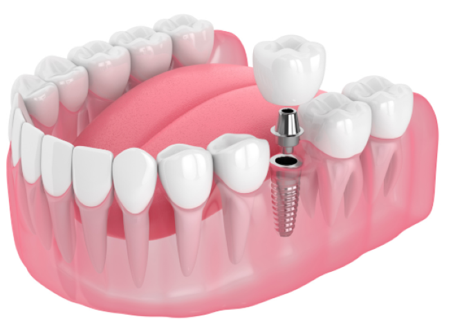 長く安心して使えるインプラント治療とは