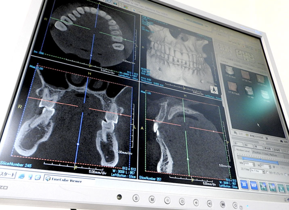 歯科ドックは、虫歯や歯周病などの口腔内トラブルを早期発見し、全身の健康を守るための精密検査です