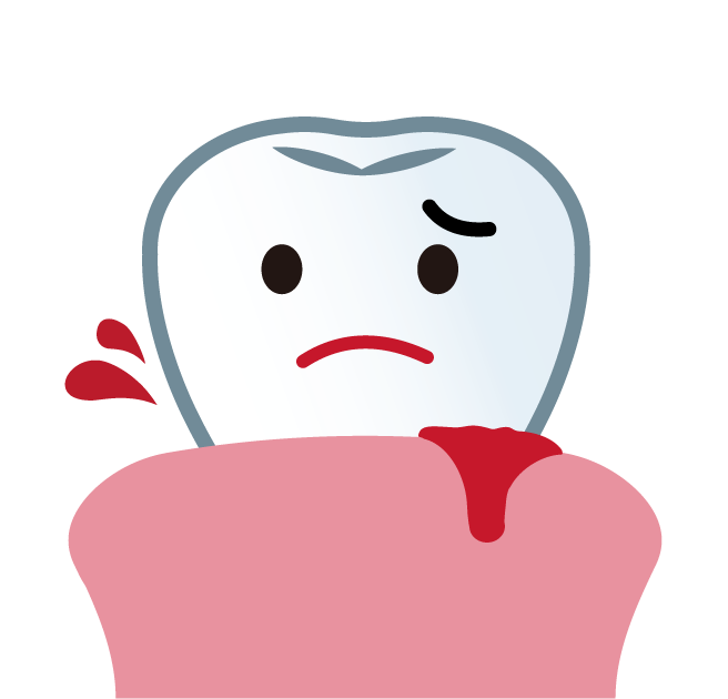 歯茎の腫れや出血がある