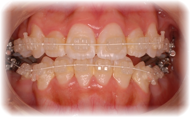 セラミックブラケット