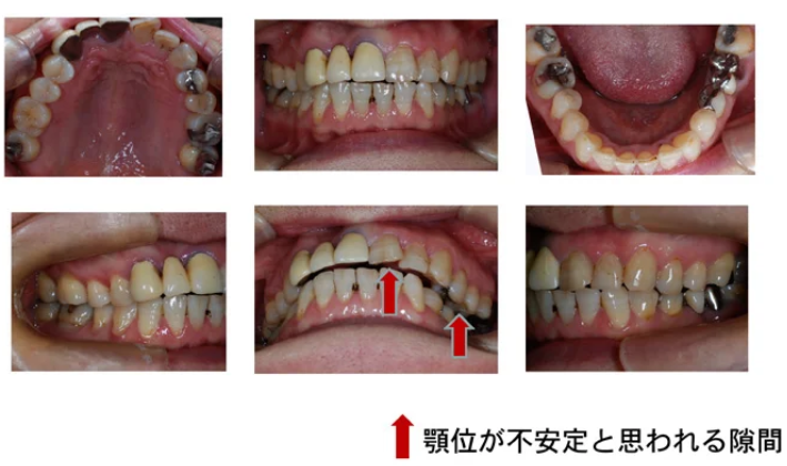 顎関節症の治療例