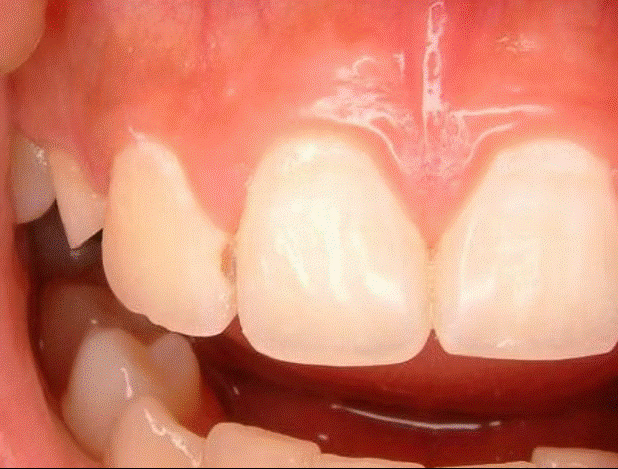 ただ削って詰めるのではなく、将来的に健康な歯を残すことを大切にした診療を実践しています。