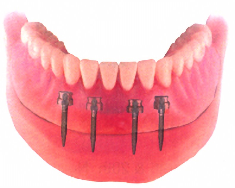 MDIミニインプラントにも対応