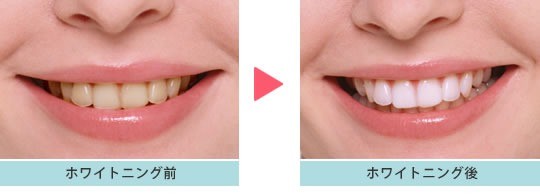 白く清潔感のある歯を長く保ちたい方に適したホワイトニング治療です。