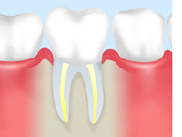 歯を根から治す根管治療