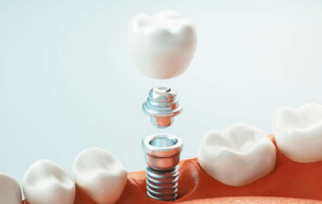 審美性に優れ、咀嚼力が高く、ブリッジや入れ歯と比べて周囲の健康な歯に負担をかけることなく、自然な歯のように機能します。