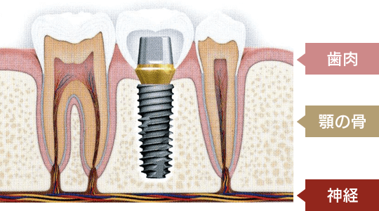チタンという金属を顎の骨と結合し、その上に歯の頭を被せます