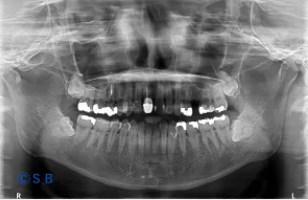 骨造成でインプラントが可能になるケースもあります