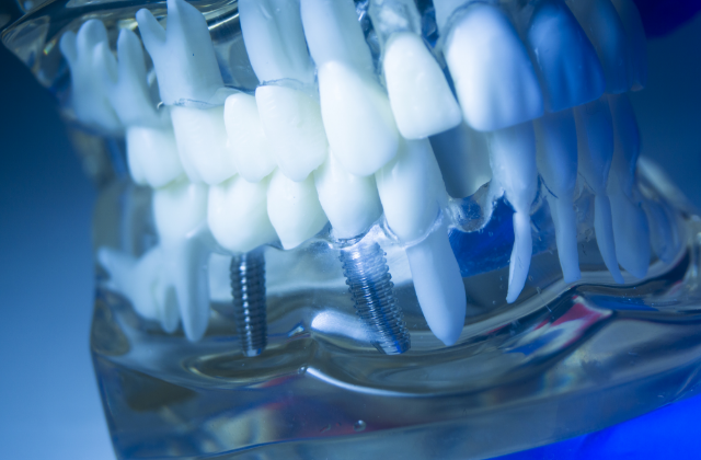 歯を失ってしまった場合は一度ご相談ください